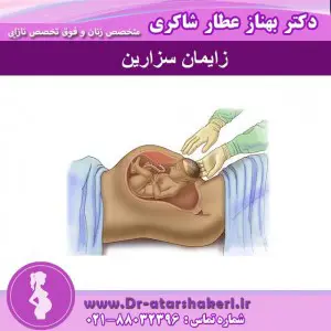 زایمان سزارین 
