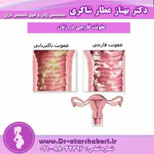 عفونت قارچی در زنان