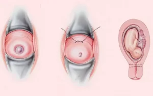 طول سرویکس دهانه رحم