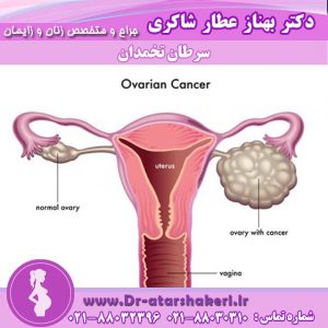 سرطان تخمدان