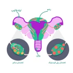 علائم سندروم پلی کیستیک