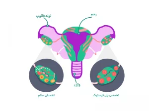 علائم سندروم پلی کیستیک
