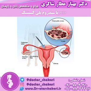 PCO یا سندروم پلی کیستیک