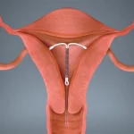 انواع IUD