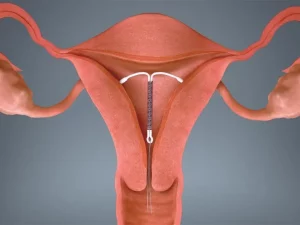 انواع IUD