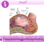 آمنیوسنتز