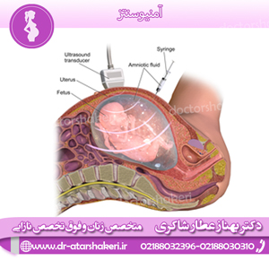 آمنیوسنتز