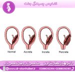 تشخیص چسبندگی جفت