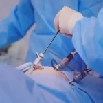 مزایای لاپاراسکوپی نسبت به جراحی باز