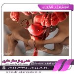 اندومتریوز و ناباروری