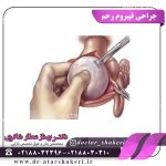 جراحی فیبروم رحم