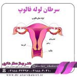 سرطان لوله فالوپ