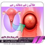 علائم زخم دهانه رحم