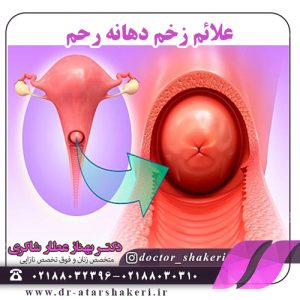 علائم زخم دهانه رحم