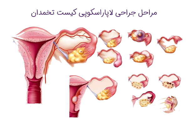 مراحل جراحی لاپاراسکوپی کیست تخمدان