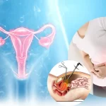 هیسترکتومی لاپاراسکوپی - دکتر بهناز عطار شاکری