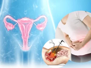 هیسترکتومی لاپاراسکوپی - دکتر بهناز عطار شاکری