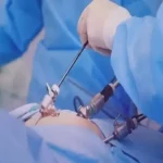 عوارض لاپاراتومی