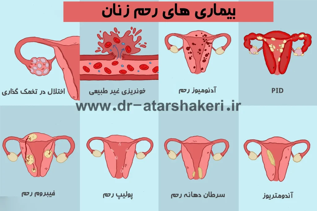 شایع ترین بیماری های رحم زنان 