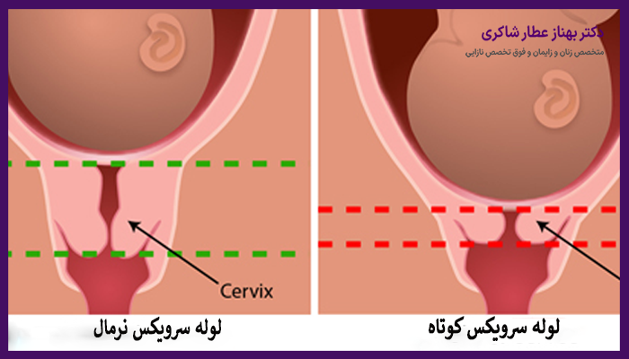 طول نرمال سرویکس در بارداری و خارج از بارداری