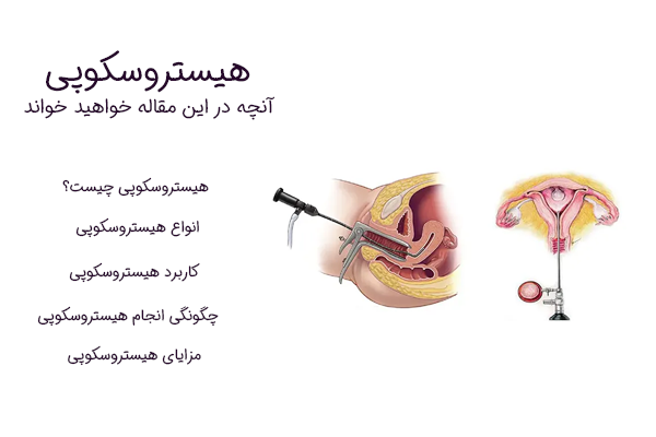 هیستروسکوپی و مزایا