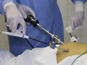 لاپاراسکوپی رحم و مراحل انجام