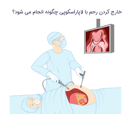 خارج کردن رحم با لاپاراسکوپی چگونه انجام می شود؟
