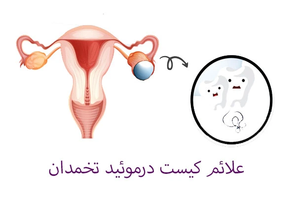 علائم کیست درموئید تخمدان