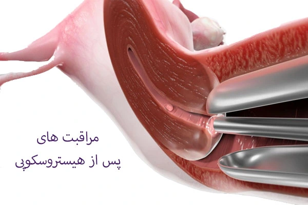 مراقبت های پس از هیستروسکوپی