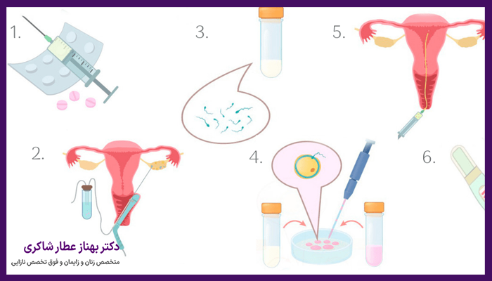 مراحل آی وی اف (IVF)