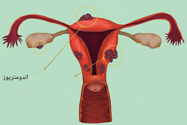 آندومتریوز-در-زنان عوارض برداشتن رحم