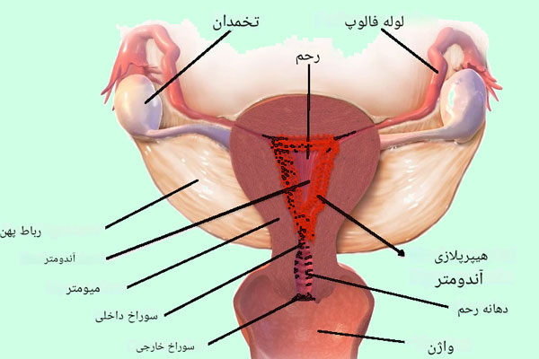 هایپرپلازی-رحم