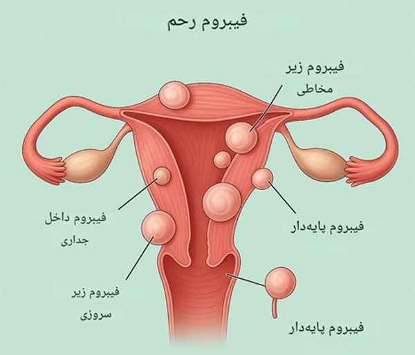 وجود-فیبروم-های-رحمی